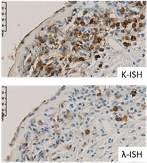 ハンナ型間質性膀胱炎における浸潤B細胞のクローナル増殖